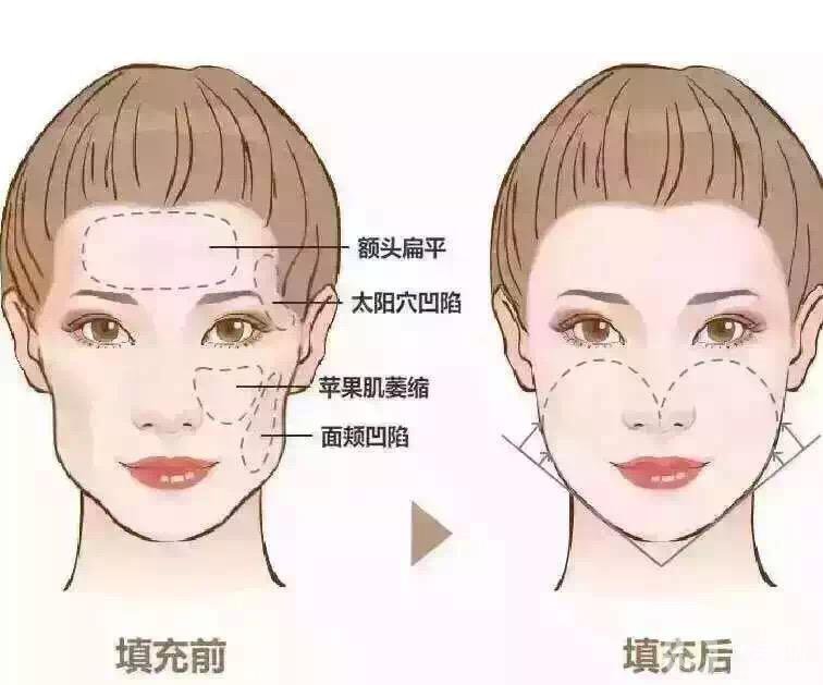 脂肪填充五年后遺癥有哪些