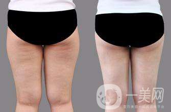 大腿抽脂對(duì)身體有害嗎?大腿抽脂多久恢復(fù)