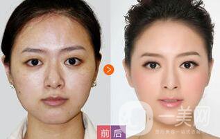 臉部填充維持多久,自體脂肪填充后*果