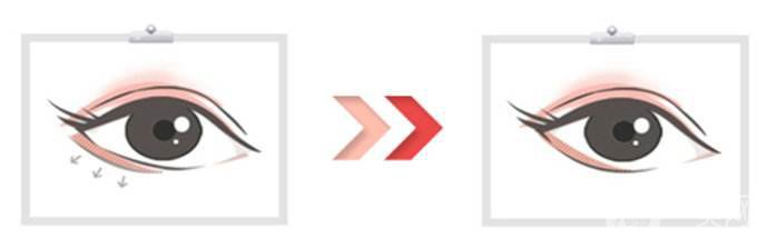 眼瞼提升術和下瞼眼瞼成形術的相關介紹