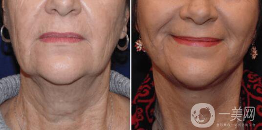 做一次面部和頸部提升可以什么*果