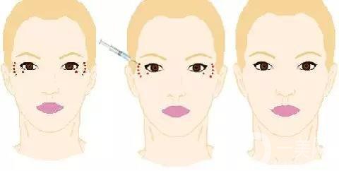 打一針除皺多少錢(qián) 打*停了會(huì)更老嗎