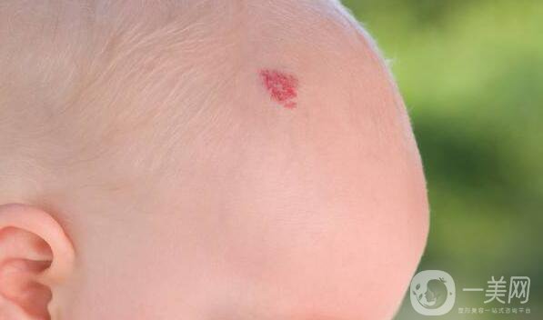 胎記的類型,去胎記方法