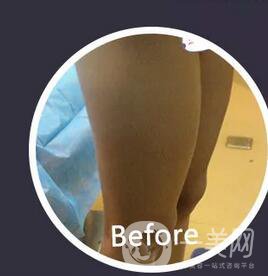 腿部環(huán)形抽脂*果