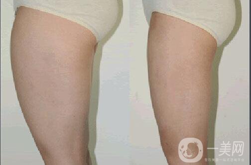 環(huán)形吸脂要多少錢 環(huán)形吸脂痛嗎