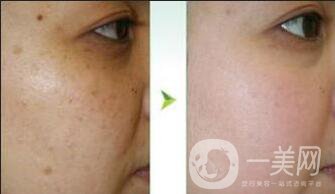 去雀斑