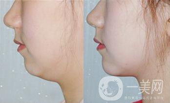 雙下巴抽脂術(shù)