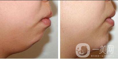 雙下巴抽脂術(shù)副作用