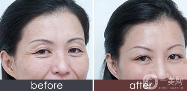 去皺針能保持多久 打去皺針初期圖片