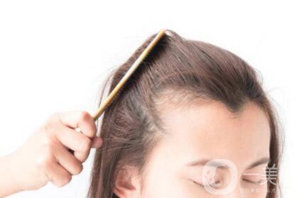 降低發(fā)際線手術(shù)好不好 有副作用嗎