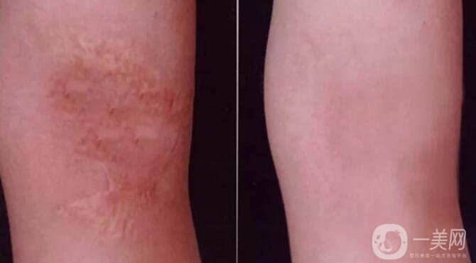 激光修復疤痕,副作用,凹陷疤痕