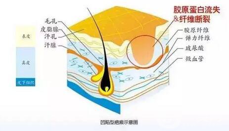 激光修復疤痕,副作用,凹陷疤痕
