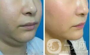 雙下巴袪脂手術(shù)多少錢