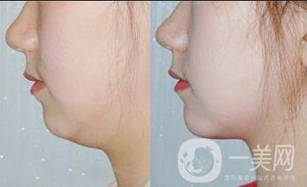 雙下巴抽脂,多久恢復(fù)