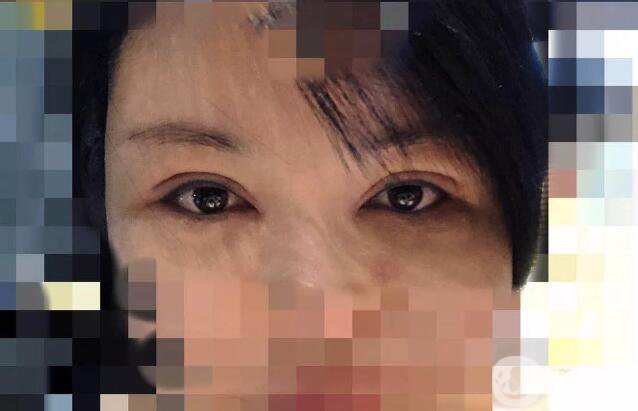 處楊曉楠雙眼皮案例 楊曉楠醫(yī)生怎么樣？
