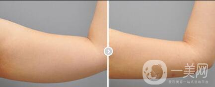 手臂舉升手術(shù)康復(fù)