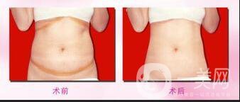 360環(huán)形吸脂,價格,多少錢,費用