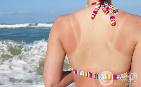 如何快速治好曬傷?來自*皮膚科醫(yī)生的15個提示