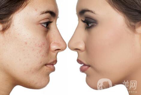 黑臉娃娃去痘*果好嗎？黑臉娃娃功*介紹