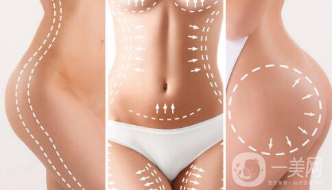 環(huán)形吸脂減肥是什么？吸脂后皮膚會不會松弛？