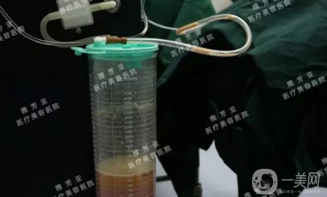 水動(dòng)力溶脂減肥,*果