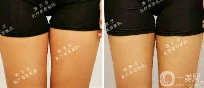 水動(dòng)力溶脂減肥,*果