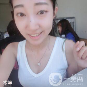 脂肪隆胸手術(shù)真實(shí)經(jīng)歷：過來人說說從A到C的改變