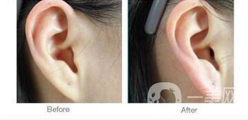 玻尿酸豐耳垂,價格,多少錢