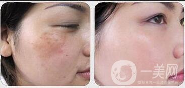 *風(fēng)范祛斑*果,*風(fēng)范祛斑多少錢(qián)