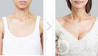 自體脂肪注射隆胸術(shù)