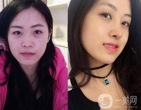 隆鼻前后照片分析 專(zhuān)家解析：隆鼻前后的變化