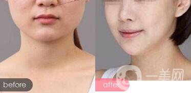 隆下巴手術(shù)前后*果圖 隆下巴的風(fēng)險(xiǎn)和恢復(fù)