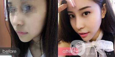 隆下巴手術(shù)前后*果圖 隆下巴的風(fēng)險(xiǎn)和恢復(fù)