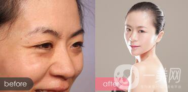 *對魚尾紋的作用：注射部位和副作用