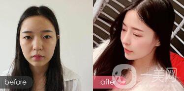 綜合鼻整形多少錢(qián)？綜合鼻整形收費(fèi)