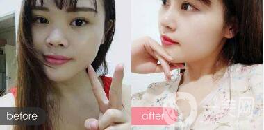 蒜頭鼻整形圖片 蒜頭鼻整形多少錢？