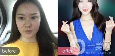 注射隆鼻整形多少要錢？微整形注射隆鼻過程