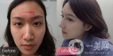 歪鼻整形痛嗎？歪鼻矯正圖片