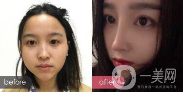 歪鼻整形痛嗎？歪鼻矯正圖片