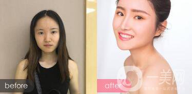 歪鼻整形痛嗎？歪鼻矯正圖片