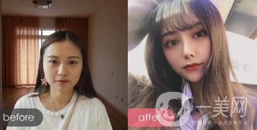 駝峰鼻整形的費(fèi)用 駝峰鼻型的女人命運(yùn)