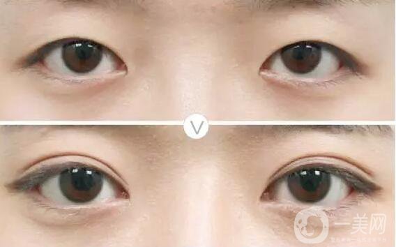 蘇李秀英醫(yī)院,割雙眼皮多少錢(qián)