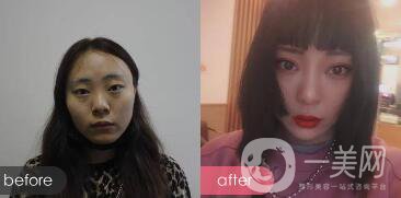 成都眼部整形專(zhuān)題 明星眼部整形