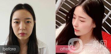 成都綜合隆鼻多少錢？綜合隆鼻真人案例