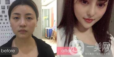 成都綜合隆鼻多少錢？綜合隆鼻真人案例