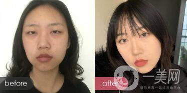 成都開(kāi)眼角多少錢呢？開(kāi)眼角案例