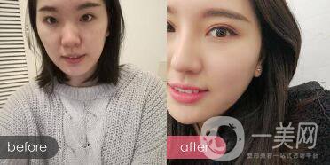 成都開(kāi)眼角多少錢呢？開(kāi)眼角案例