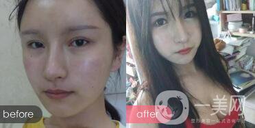 成都開(kāi)眼角多少錢呢？開(kāi)眼角案例