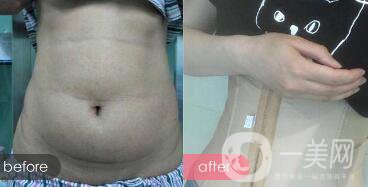 成都抽脂減肥價格多少?成都抽全身脂要多少錢?