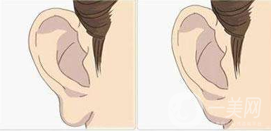 玻尿酸豐耳垂的*果原來這么好 一起來看看吧